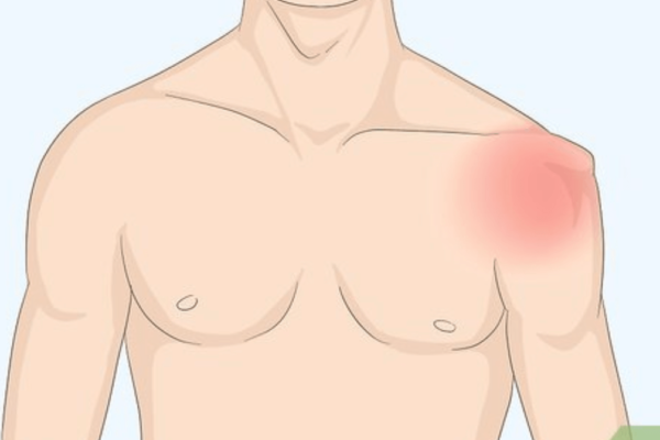 Shoulder DislocationHow It Happens and What to Do if it Happens to You